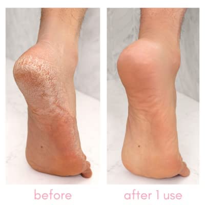 Kiara Sky Heeling Callus Remover (Kit) - Image 2