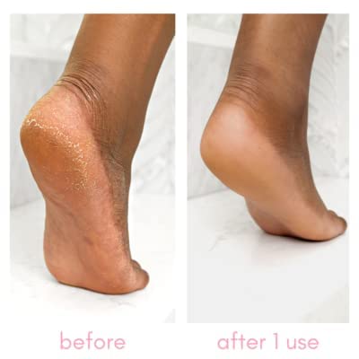 Kiara Sky Heeling Callus Remover (Kit) - Image 3